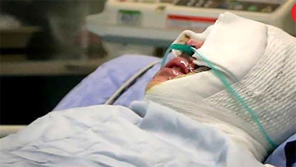 اسیدپاشی هولناک به دختر جوان در «طرشت»